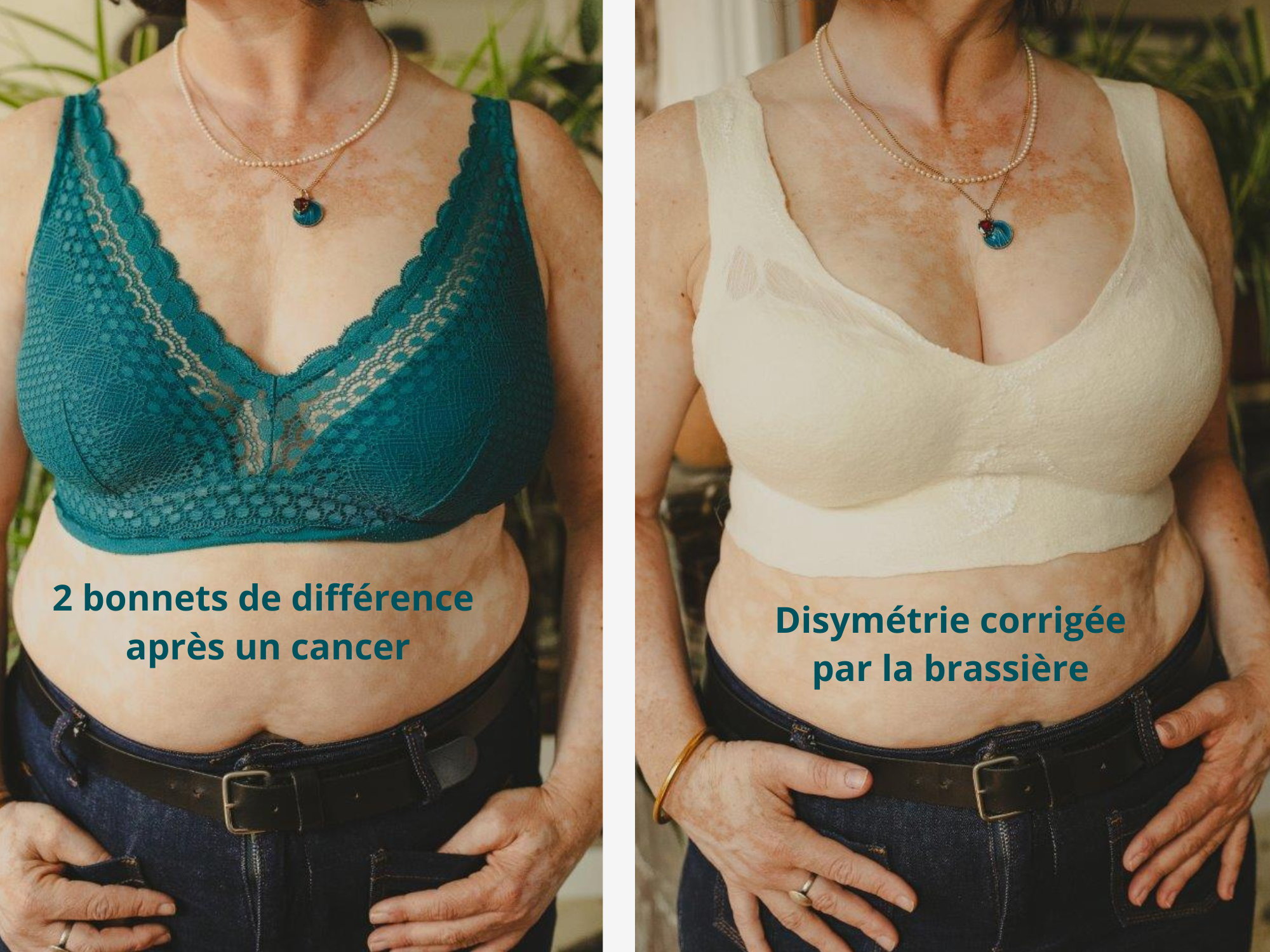 ap Cancer disymetrie 1_Brassiere